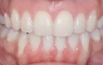 Emma's smile transformation