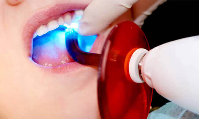 Dental Sealants