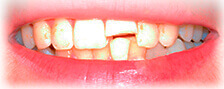 Before - CASE # 1: Emergency Treatment - Fractured Tooth