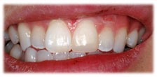 CASE #11: Emergency Treatment - Broken/Chipped Teeth (after)