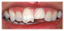 CASE #11: Emergency Treatment - Broken/Chipped Teeth (before)