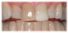 CASE #12: Veneers - Stained Teeth (before)