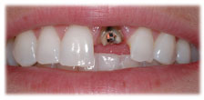 CASE #13: Emergency Treatment - Fractured Tooth (before)