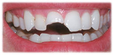 CASE #17: Emergency Treatment - Broken Teeth (before)