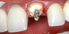 CASE #19:  Emergency Treatment - Fractured Tooth (before)