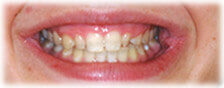 Before - CASE # 2: Cosmetic Dentistry - Lumineers
