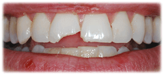 CASE #23: Emergency Treatment - Fractured Tooth (before)