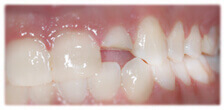 CASE #25: Emergency Treatment - Fractured Tooth (before)