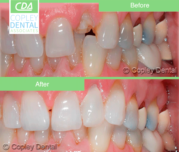 CASE # 3: Emergency Treatment - Fractured or Broken Tooth