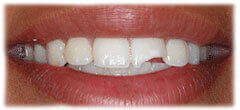 CASE #36: Emergency Treatment - Broken tooth (before)