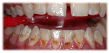 Before - CASE # 4: General and Cosmetic Dentistry - Cleaning - Teeth Whitening
