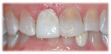 After - CASE # 5: Emergency Treatment - Fractured or Broken Tooth
