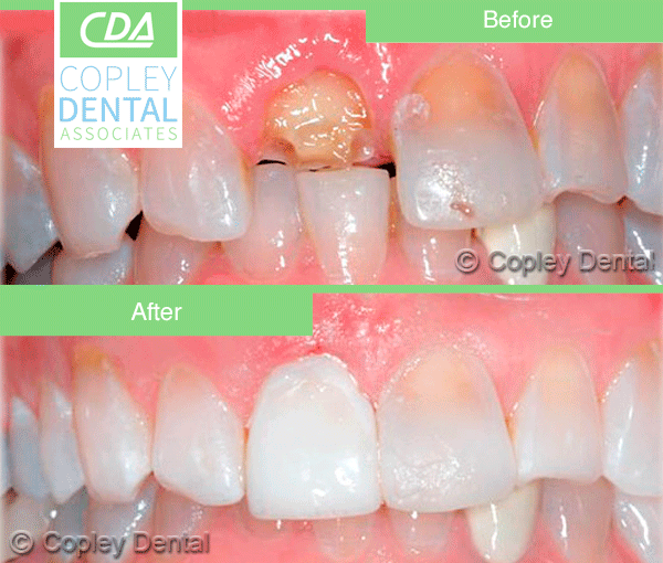 CASE # 5: Emergency Treatment - Fractured or Broken Tooth