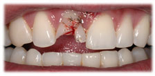 CASE #7: Emergency Treatment - Fractured Tooth (before)