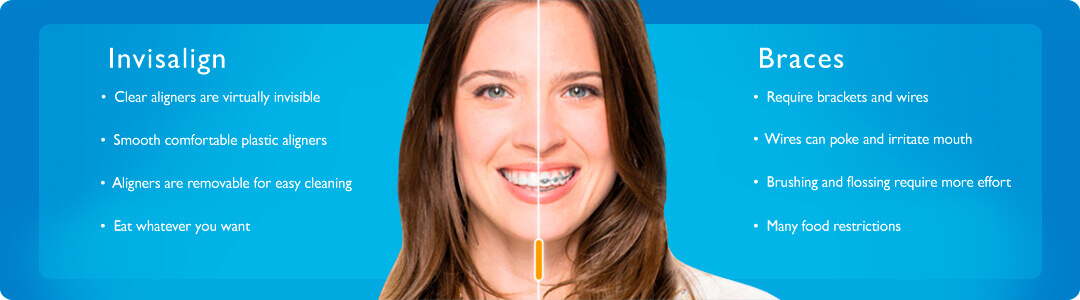 Invisalign - Clear Aligners