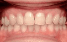 Sarah's smile transformation