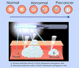 Oral Cancer Detection Technology